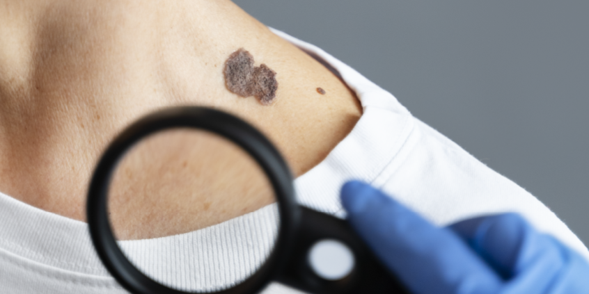 Skin Cancer Screenings are Important ALL YEAR – Veterans Outreach Ministries – Delaware Skin Cancer Screenings are Important ALL YEAR - Veterans Outreach Ministries - Delaware